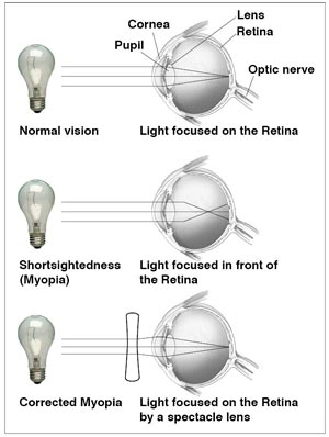 látásból fejfájása lehet látásélesség vizsgálata atropinizáció során